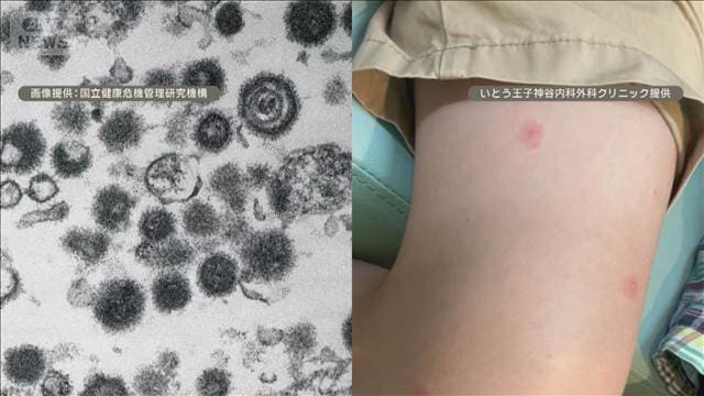 「ブレイクスルー水痘」流行注意　再感染や予防接種後にも「すり抜けるような感染」