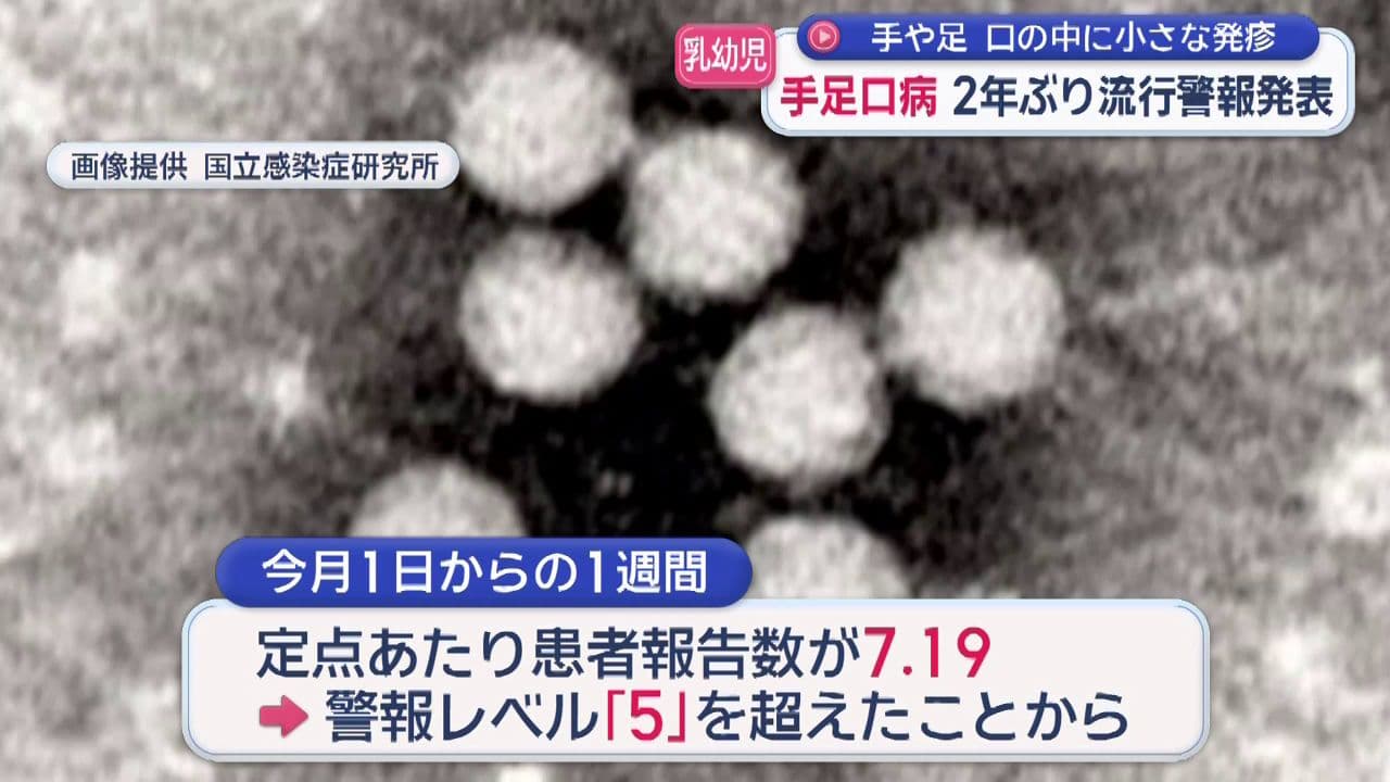 手や足に発疹が現れる「手足口病」２年ぶりに流行警報を発表