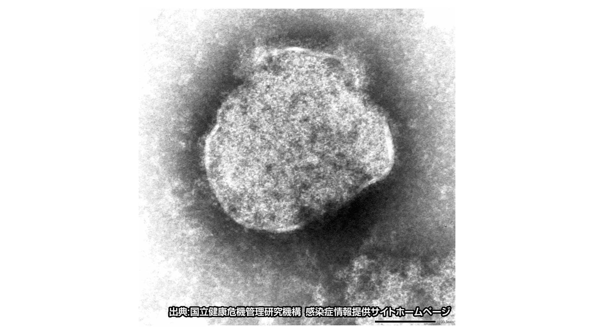 長崎市20代女性が麻しん(はしか)感染 県外の患者と接触歴あり 県内で今年2例目
