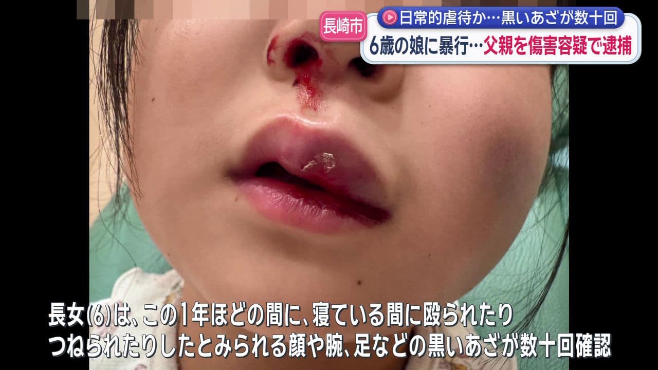 長崎市で小学生の娘に暴行…傷害容疑で父親（27）逮捕　娘は数十回顔あどに黒いあざ　日常的虐待も視野に捜査