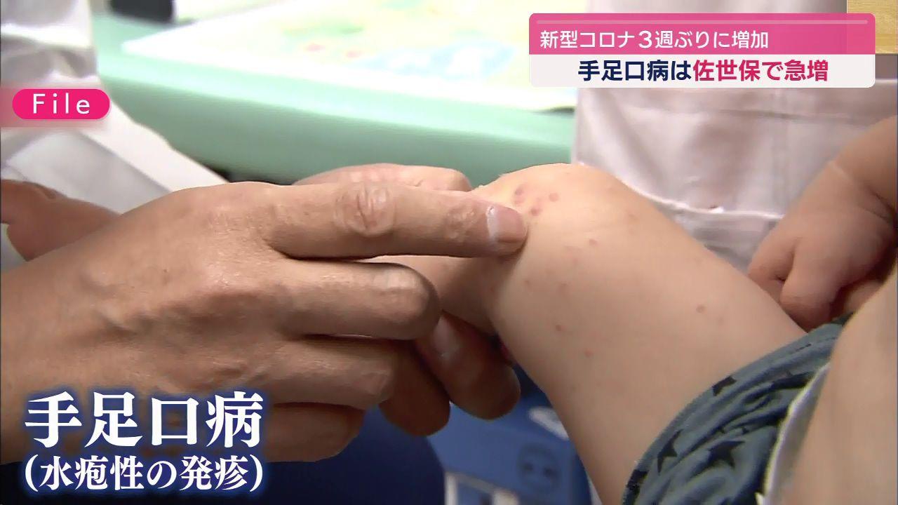 県内の新型コロナ３週ぶりに増加 佐世保市では手足口病が急増